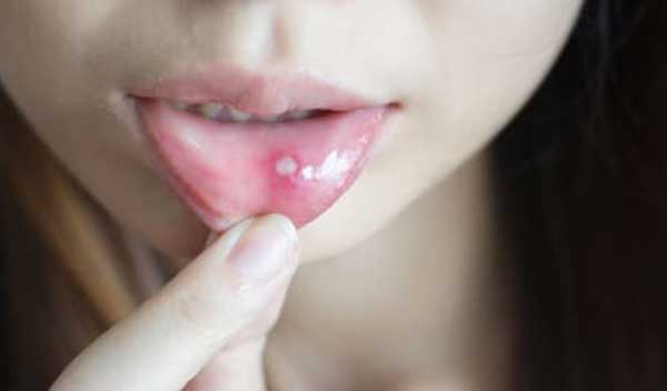 The Causes and Treatments for Canker Sores