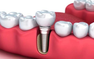 Diamond Bar Dental Implants
