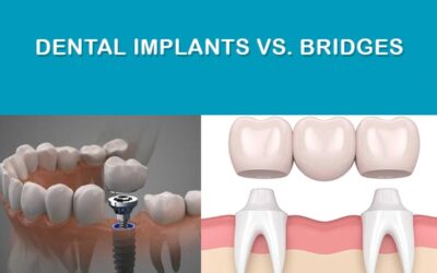 Dental Implants vs. Bridges: Which Is Best for You?
