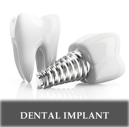 Best Dental Implant service near Diamond Bar
