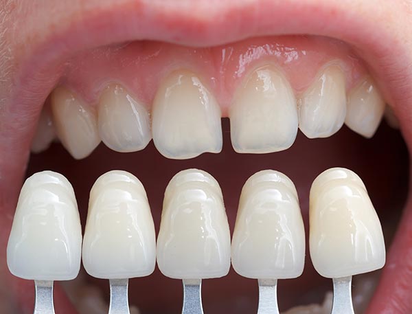 Do Dentists in Diamond Bar Offer Veneers?