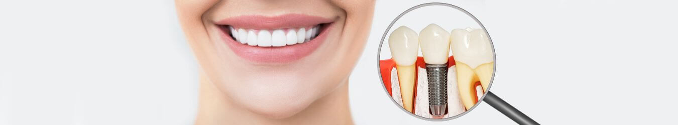 Women Smiling Dental Implant