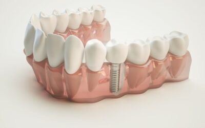 Getting Dental Implants: What You Need to Know