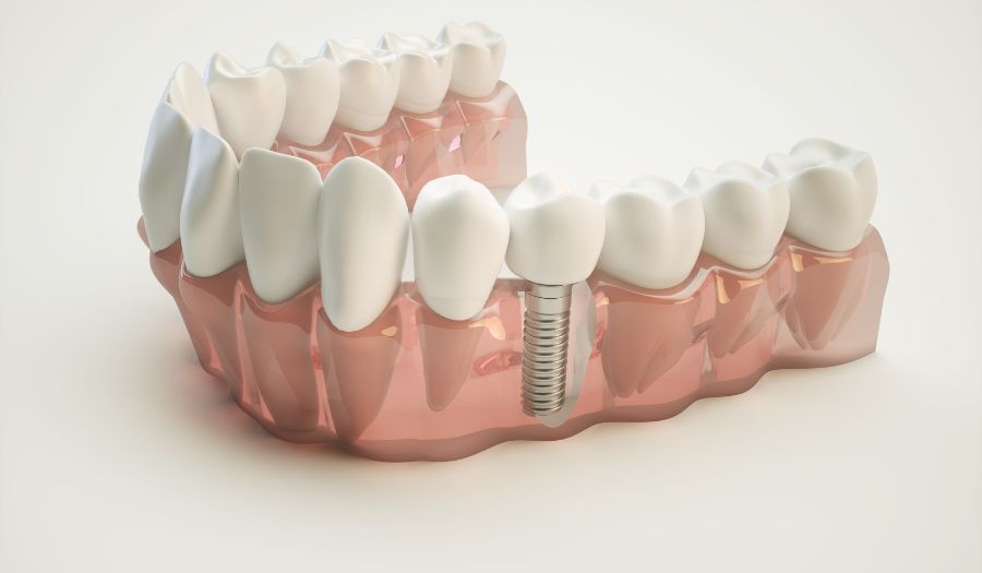 Getting Dental Implants: What You Need to Know