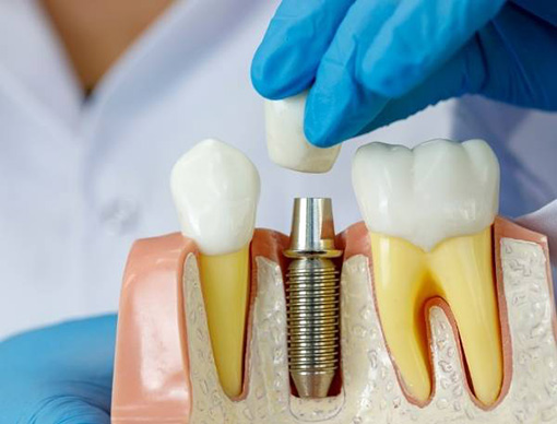 Dental Implant teeth model