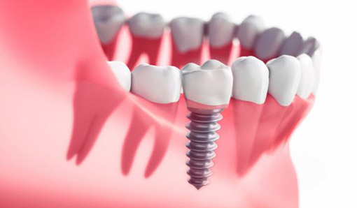 Dental Implants in Pomona