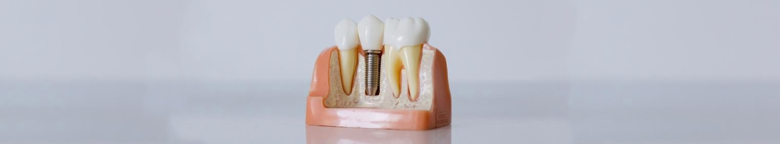 Dental Implant model teeth