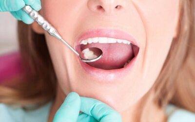 White Fillings vs Silver Fillings What You Need to Know