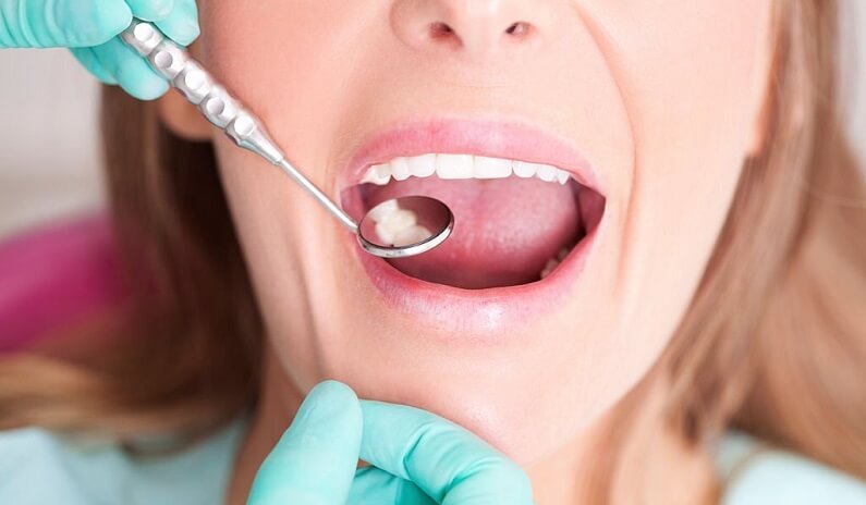 White Fillings vs Silver Fillings What You Need to Know