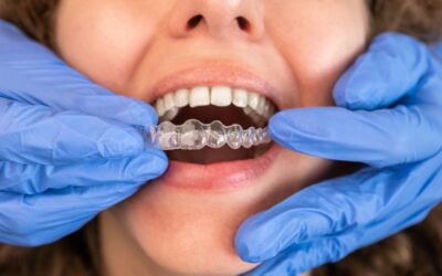 Top 5 Reasons Adults Choose Invisalign To Straighten Their Teeth