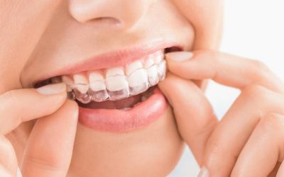 Straight Talk: What You Need to Know Before Getting Invisalign